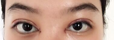 韓式微創(chuàng)雙眼皮恢復圖 深圳妍熙雙眼皮半年