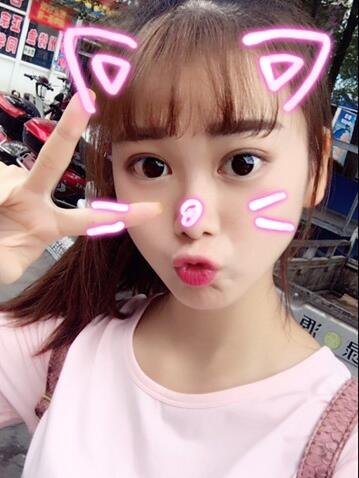 韓式微創(chuàng)雙眼皮恢復圖 深圳妍熙雙眼皮半年