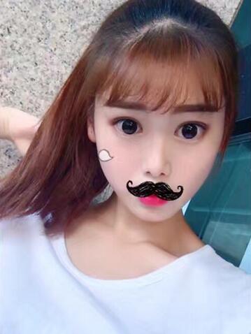 韓式微創(chuàng)雙眼皮恢復圖 深圳妍熙雙眼皮半年