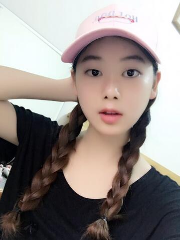 韓式微創(chuàng)雙眼皮恢復圖 深圳妍熙雙眼皮半年