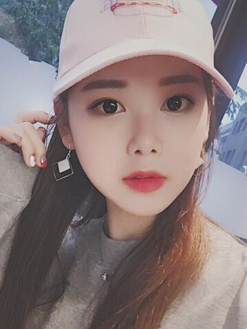 韓式微創(chuàng)雙眼皮恢復圖 深圳妍熙雙眼皮半年