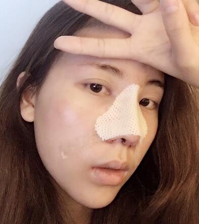 北京藝星王英勇隆鼻案例 隆鼻整形三個(gè)月