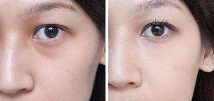 超聲波去眼袋降低風險嗎 超聲波去眼袋多少錢