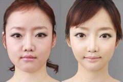 一位美女網(wǎng)友的自述削骨手術(shù)過(guò)程