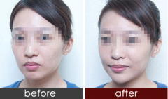 解析！下巴整形填充是假體好還是打玻尿酸好？