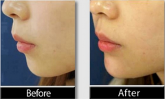 玻尿酸豐下巴適合的人群，玻尿酸的優(yōu)點(diǎn)解析