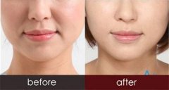 解析!玻尿酸填充下巴需要打幾只？果怎么樣？