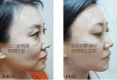 面部塌陷松弛有皺紋怎么辦？埋埋提升果能管多久？