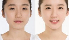 墊下巴可以改變臉型嗎？