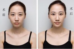 墊下巴有哪些手術(shù)方法？