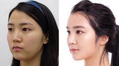 墊下巴可以維持多久？能永.久嗎？