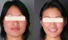 顴骨整形有哪些方法？