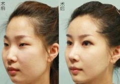 顴骨整形后應(yīng)該如何護(hù)理？