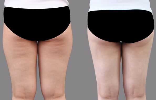 大腿吸脂減肥術(shù)后多久恢復(fù)，幾天能消腫