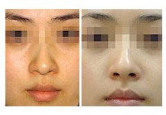 黑臉娃娃成好嗎？成都哪家醫(yī)院做得好？價格多少錢？