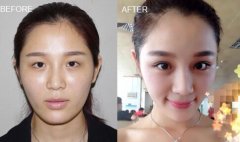 哪些人不適合做雙眼皮修復手術