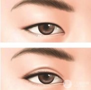 八大處雙眼皮失敗修復價格 雙眼皮失敗修復多少錢