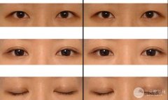 武漢割雙眼皮失敗修復要做哪些準備