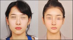 哪些人不能做下頜角磨骨手術(shù)？截骨術(shù)前術(shù)后注意事項(xiàng)