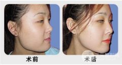 自述，下頜角截骨整形是怎樣的感受