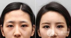 玻尿酸和自體脂肪，哪個(gè)填充淚溝果更好？