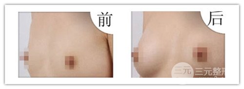 假體隆胸后可以運動嗎，可以鍛煉嗎