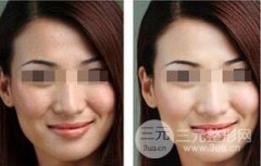 全身激光美白需要多少錢？