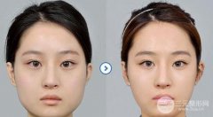 哪家醫(yī)院做削骨手術(shù)比較降低風(fēng)險(xiǎn)？