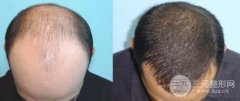 毛發(fā)美容頭發(fā)種植術過程是怎樣的?果好不好?