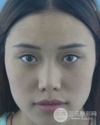 我眼部做雙眼皮整形失敗可以手術(shù)修復(fù)嗎？北京要多少錢(qián)？