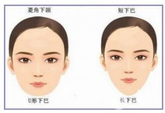 下頜角整形術(shù)后會(huì)不會(huì)出現(xiàn)后遺癥？