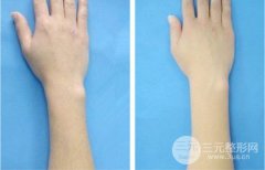 飛頓冰點脫毛果好不好了