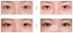 開眼角成好嗎，術(shù)后多久可以畫眼線