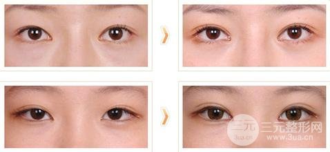 開眼角成好嗎，術(shù)后多久可以畫眼線