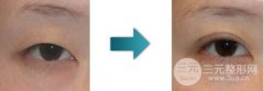 雙眼皮手術(shù)為什么會(huì)失敗，雙眼皮修復(fù)有哪些方法