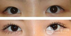 做開內(nèi)眼角和外眼角手術(shù)有哪些區(qū)別