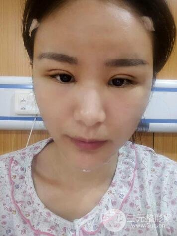 芭比雙眼皮多項整形前后對比照片 青島諾德曹繼武雙眼皮案例