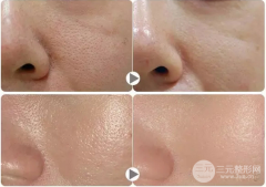 怎樣快速又有的祛除黑頭縮小毛孔？