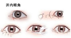 做開眼角手術(shù)多久恢復(fù)？應(yīng)該注意什么問題？