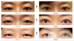 上眼皮松弛怎么辦？上眼瞼下垂矯正方法大全