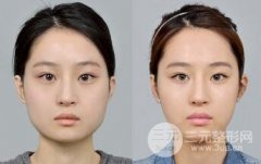 下頜角整形貴不貴？北京下頜角整形多少錢？