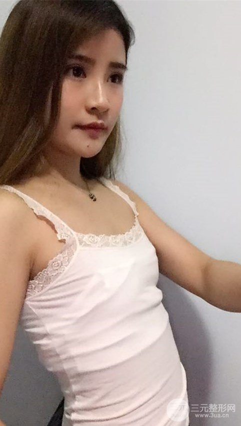 淄博陽光整形自體脂肪隆胸前后對比圖，真實案例