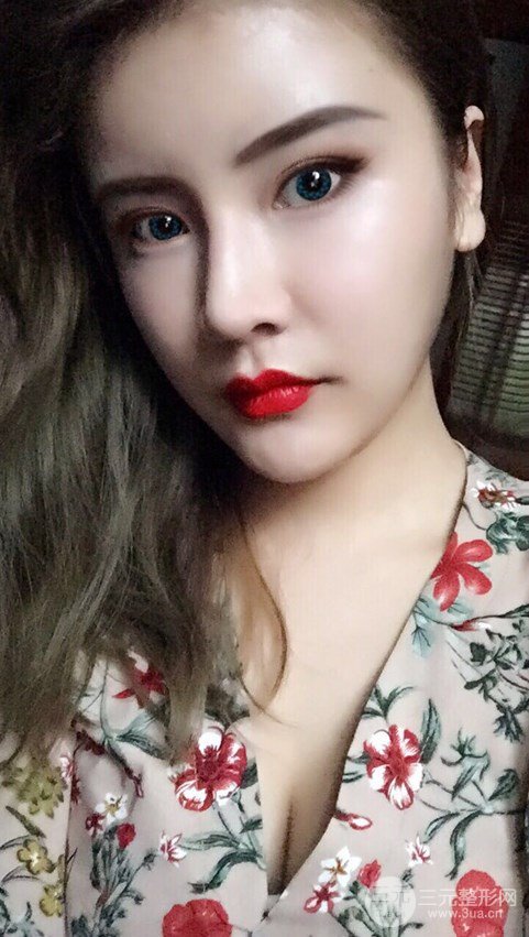 淄博陽光整形自體脂肪隆胸前后對比圖，真實案例