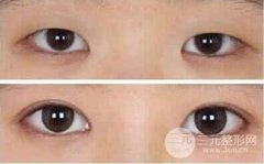 眼部整形開眼角手術(shù)會反彈嗎？