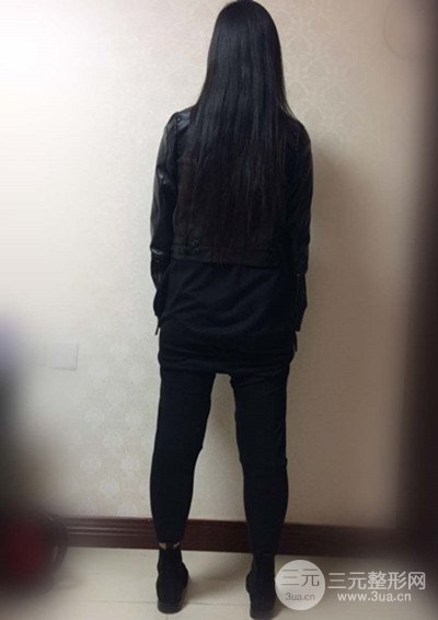 大腿抽脂真實過程圖，輕松擁有細長雙腿