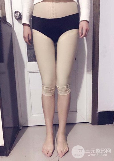 大腿抽脂真實過程圖，輕松擁有細長雙腿