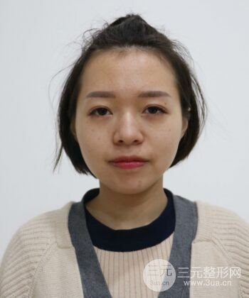 硅膠假體隆鼻+耳軟骨墊鼻尖四個月恢復(fù)果圖