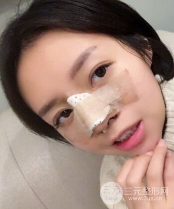 硅膠假體隆鼻+耳軟骨墊鼻尖四個月恢復(fù)果圖