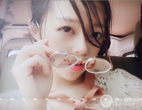 硅膠假體隆鼻+耳軟骨墊鼻尖四個月恢復(fù)果圖