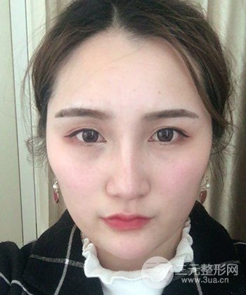 面部埋埋蛋白線.提升前后對(duì)比照片，皮膚緊致了不少